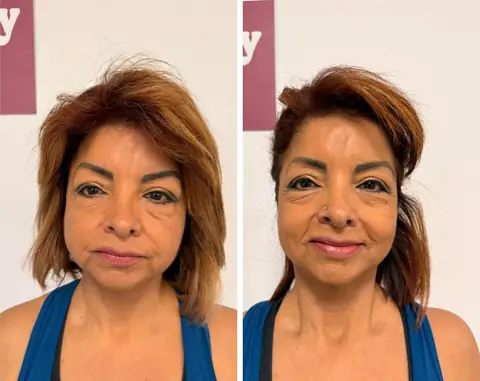 Image avant et après d’une membre du club, côté face